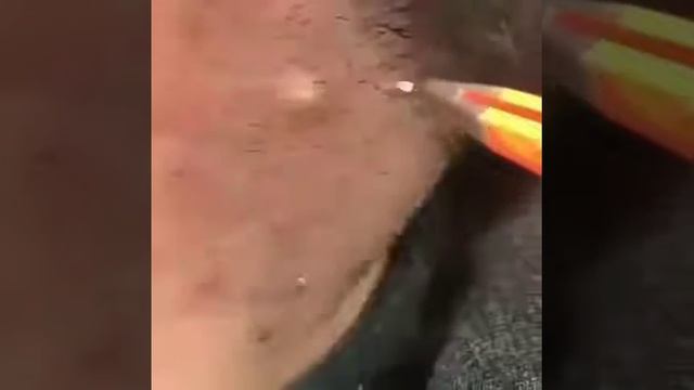 Удаление вросшего волоса