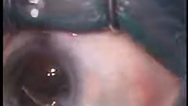 Операция на глаз ФЭК, ИОЛ смотреть онлайн