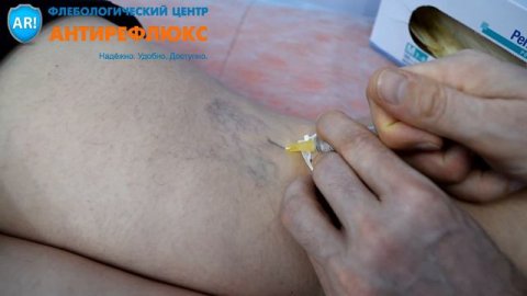 Склеротерапия сосудистых звездочек