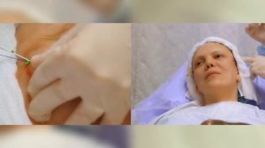 Мезонити Cog | подтяжка лица | косметология 2017