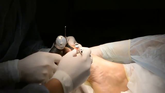 Удаление шишек на ногах. Коррекция халюкс вальгус