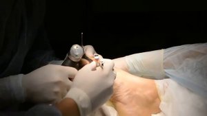 Удаление шишек на ногах. Коррекция халюкс вальгус
