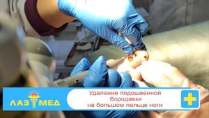Удаление подошвенной бородавки на большом пальце ноги