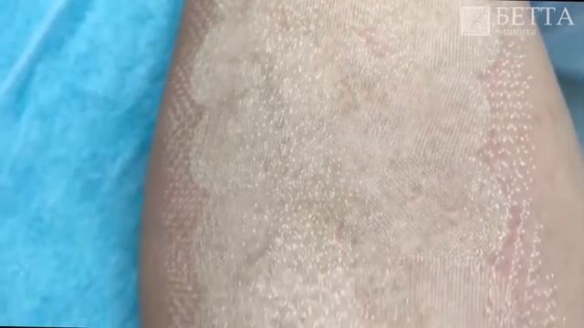 Лечение рубца после ожога на СО2 лазере. Лазерная шлифовка рубца Нижний Новгород. "БЕТТА КЛИНИКА". смотреть онлайн