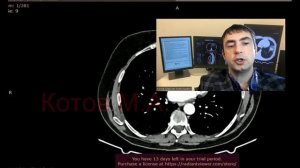 Дивертикул мочевого пузыря. Ролик №58