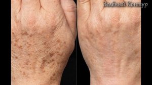 Действенное средство от пигментных пятен на коже