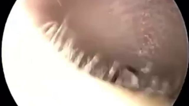 Извлечение клеща из слухового прохода смотреть онлайн