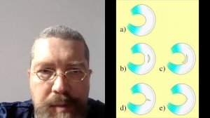 МЕНИСК коленного сустава восстановится без операции, если вы