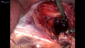 Laparoscopic Heller cardiomyotomy LIVE _ Кардиомиотомия при халази кардии.mp4