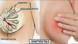 Лактостаз