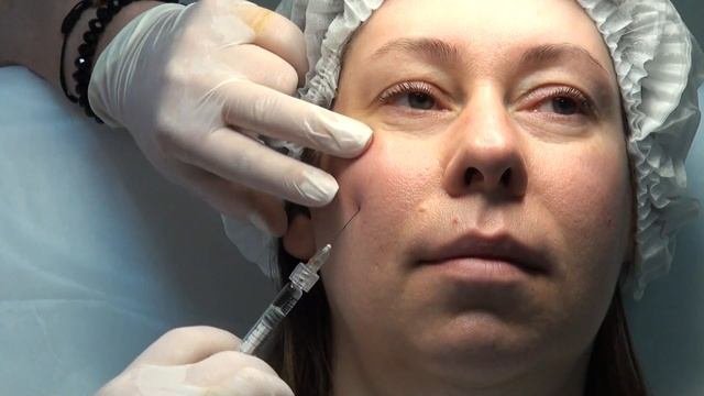 Коррекция скул и подбородка Princess Filler