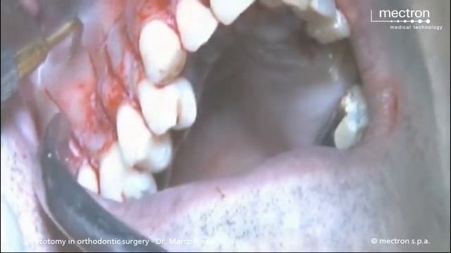 Ортодонтическая кортикотомия смотреть онлайн