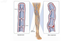 Она ИЗБАВИЛАСЬ от ВАРИКОЗНОГО РАСШИРЕНИЯ ВЕН с помощью ПРОСТОГО РЕЦЕПТА