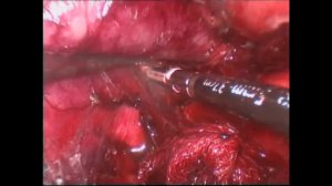 Лапароскопическая нефректомия справа & удаление опухолевого тромба нижней полой вены рентген сосу