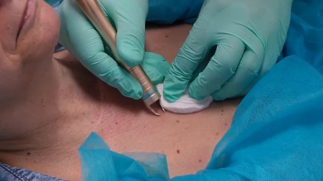 Как Удалить Ангиомы и Папилломы Диодным Лазером смотреть онлайн