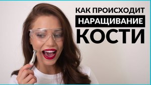 Что такое наращивание кости. Как происходит синус-лифтинг