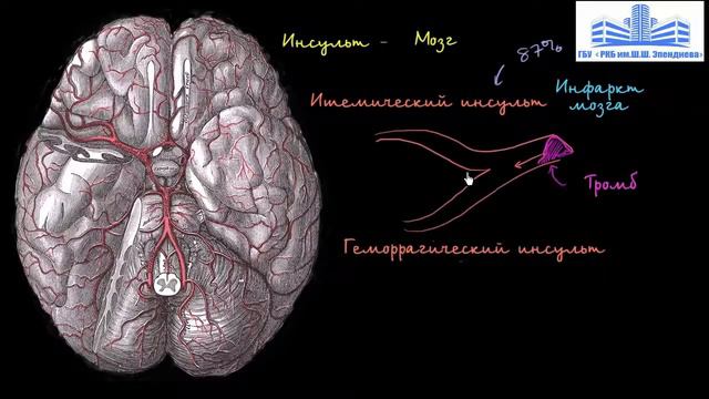 ЧТО ТАКОЕ ИНСУЛЬТ смотреть онлайн