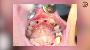 Имплантация зубов в пожилом возрасте Д А  Воробьев