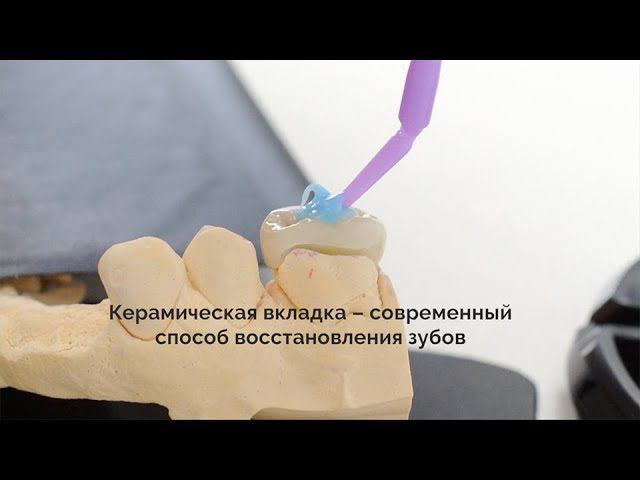 Керамическая вкладка –  вместо пломбы для зубов | стоматологическая клиника Самара