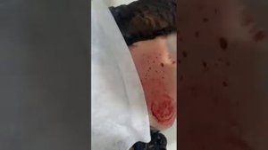 капилляротерапия лица