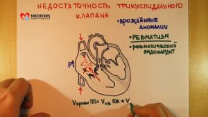 Недостаточность трёхстворчатого клапана Просто о сложном