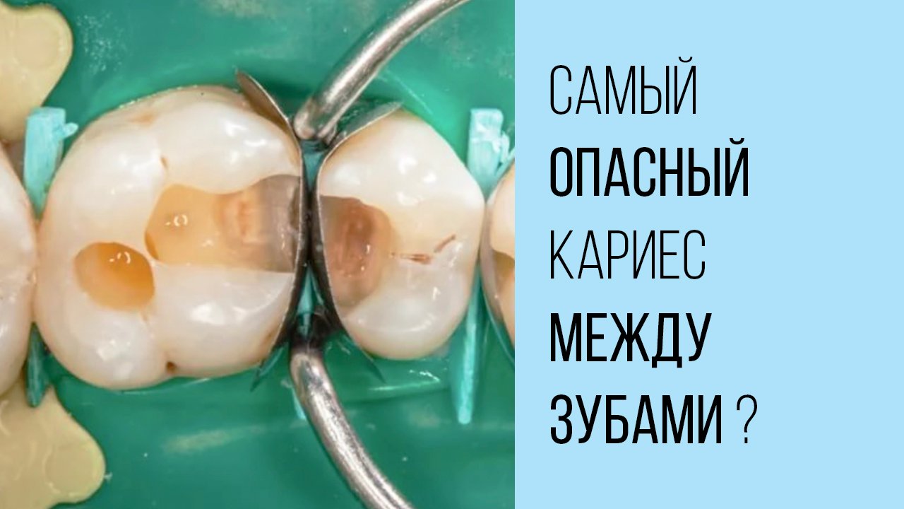 Как лечить кариес между зубами❓