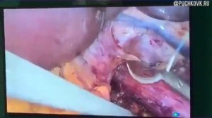 ГПОД парциальная фундопликация по Тоупе 270 градусов