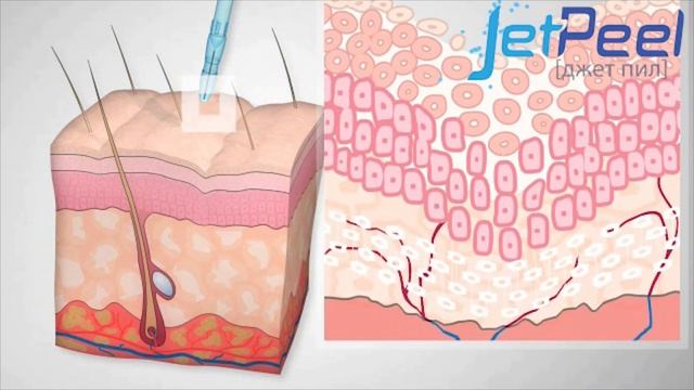 Процедура на аппарате JET PEEL
