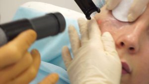 Удаление вены под глазом лазером