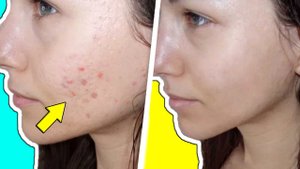 Как избавиться от прыщей за 1 день рецепт - Лучшая маска для лица от прыщей