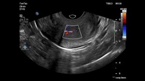 Полип цервикального канала