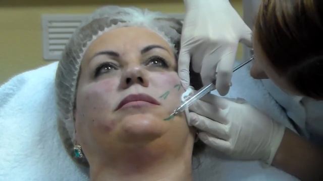 Векторный лифтинг NEAUVIA смотреть онлайн