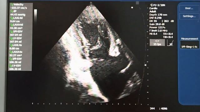 Аортальный стеноз Определение тяжести по рекомендациям ASE смотреть онлайн