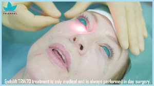 2023 year best supplier for endolift laser