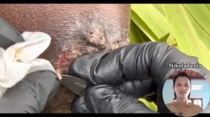 part 18 : jigger feet removal ? ( please subscribe ) #nikolatesla