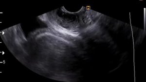 Парауретральная  киста на УЗИ органов малого таза.