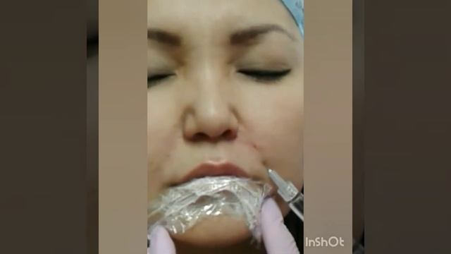 Коррекция носогубная складки филлером