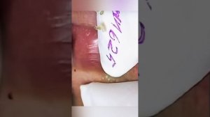 Акне. Черные точки. Вросшие волосы и прыщи.