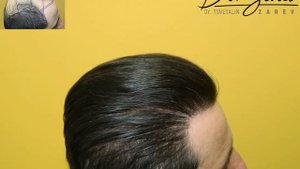 FUE Hair Transplant Result (12 890 Scalp Grafts)- Dr Zarev, Bulgaria