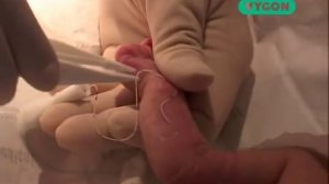 8 Извлечение катетера