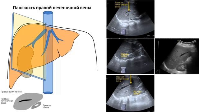 Цирроз Печени Узи Фото