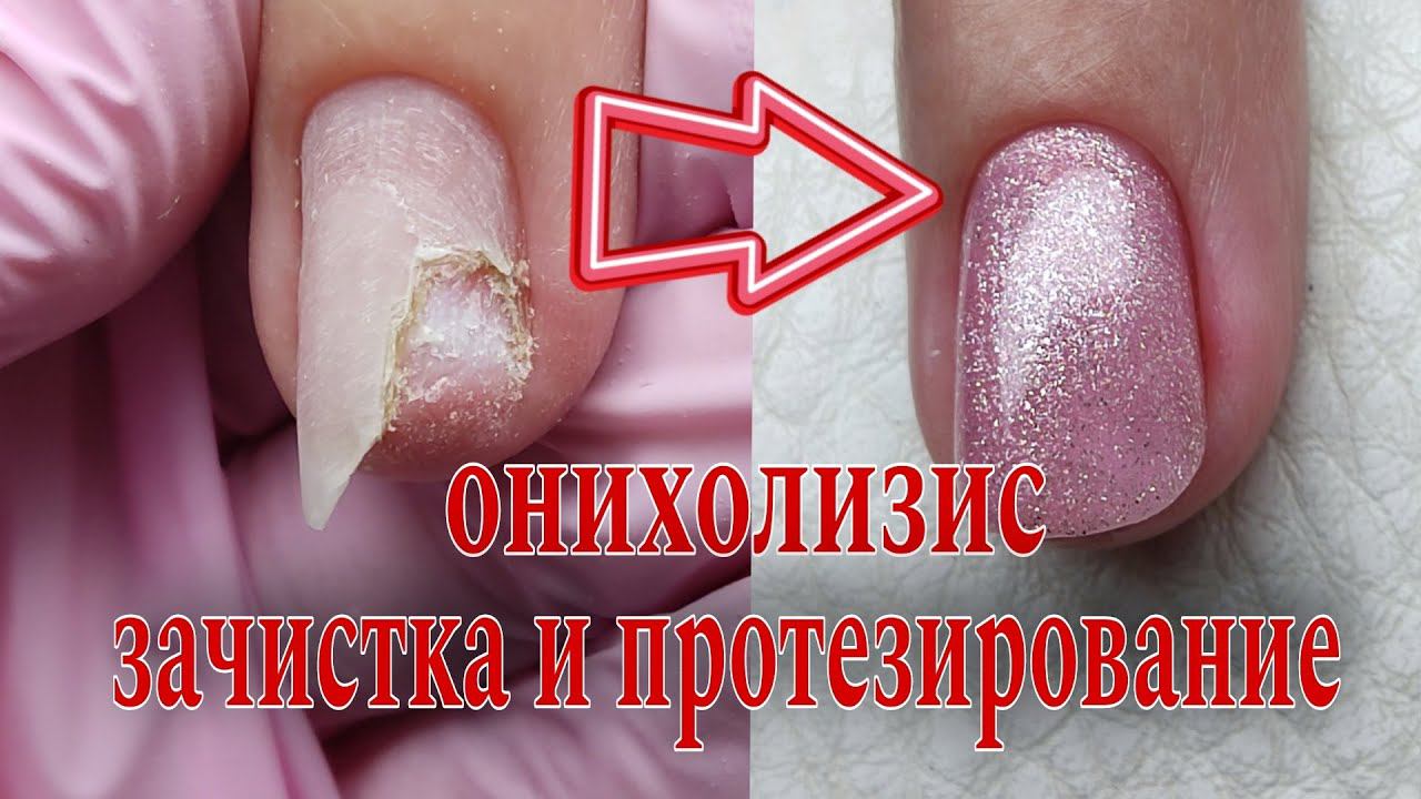 ОНИХОЛИЗИС/ зачистка и протезирование