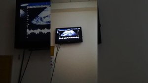 Узи 13 недель и 3 дня