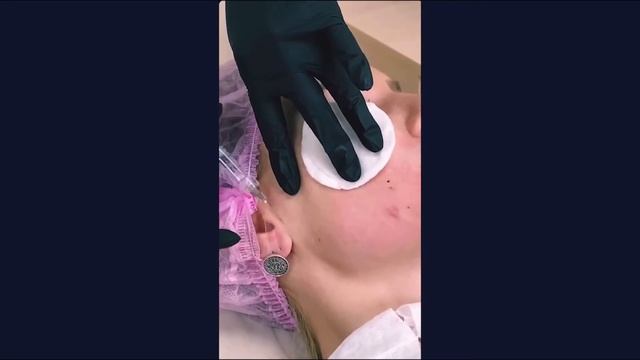 Биоармирование бифазным филлером