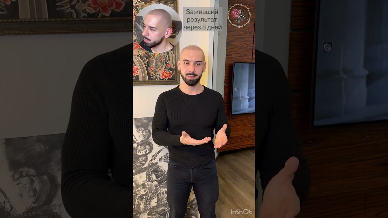 Клиент заехал показать результат через 8 дней. Трихопигментация лучше чем пересадка волос SMP