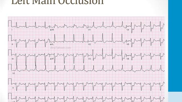 Кардиология USMLE - 2. Ишемия сердца - 3.STEMI