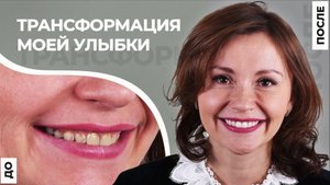 Трансформация улыбки винирами. Моя улыбка ДО и ПОСЛЕ. Зачем нужны виниры?