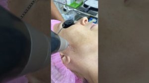 Лазерное удаление пигментных пятен на лице