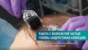 Восстановления волос при андрогенной алопеции