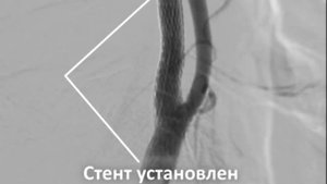 Стентирование сонных артерий
